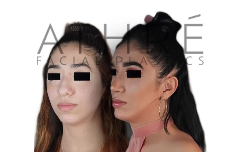 Before and after female ethnic rhinoplasty showing smoother nasal bridge and enhanced tip definition by Dr. Raghu Athré.