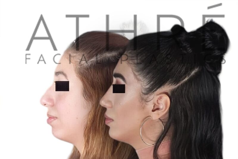 Before and after female ethnic rhinoplasty with dorsal hump reduction and refined nasal tip by Dr. Raghu Athré.