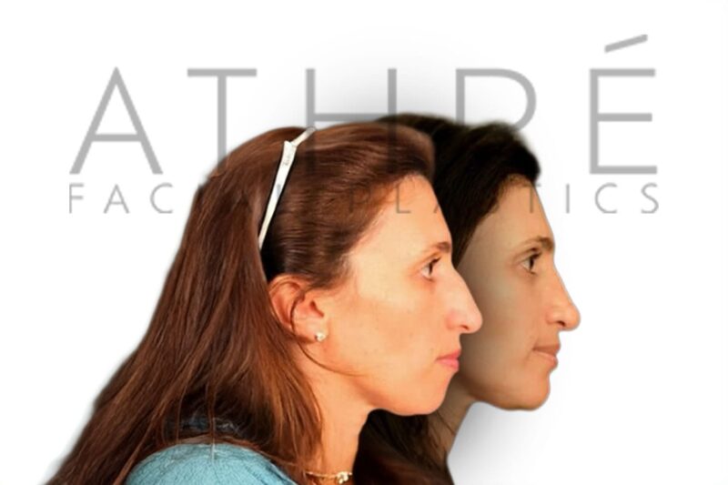 Before and after female rhinoplasty with smoother nasal bridge and refined tip contour by Dr. Raghu Athré.