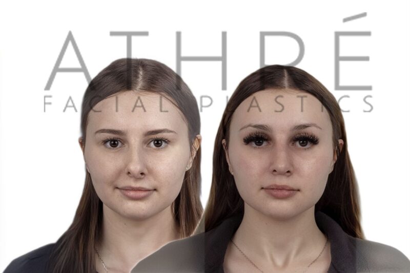 Before and after female rhinoplasty addressing prior nasal trauma with refined nasal contour by Dr. Raghu Athré.