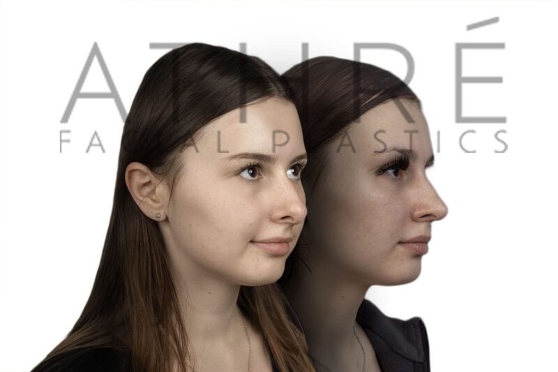 Before and after female rhinoplasty after nasal trauma with smoother bridge contour and refined tip definition by Dr. Raghu Athré.