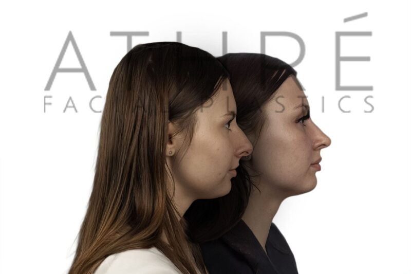 Before and after female rhinoplasty correcting effects of prior nasal trauma with refined tip contour by Dr. Raghu Athré.