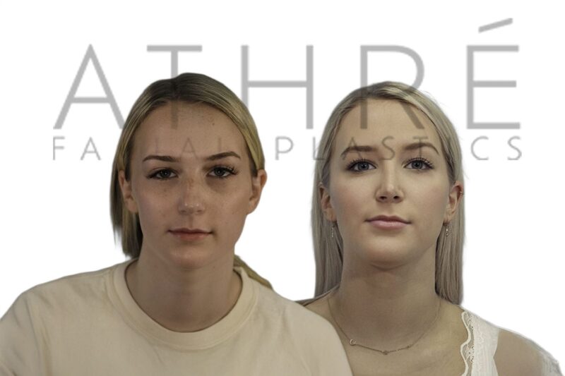 Before and after female rhinoplasty with smoother bridge profile and refined nasal tip definition by Dr. Raghu Athré.
