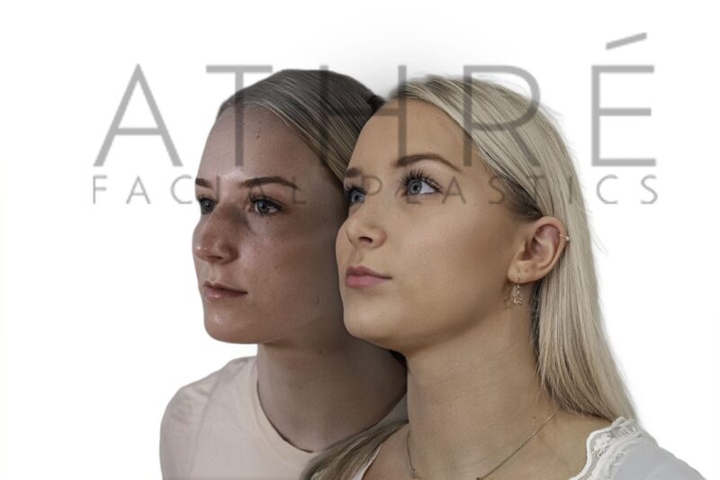Before and after female rhinoplasty with refined nasal bridge and enhanced tip contour by Dr. Raghu Athré.