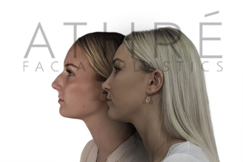 Before and after female rhinoplasty showing dorsal hump reduction and refined nasal tip by Dr. Raghu Athré.