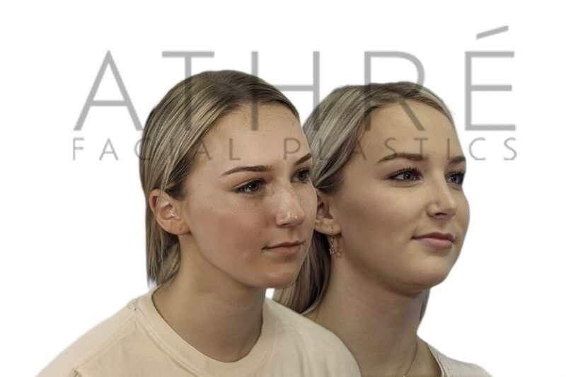Before and after female rhinoplasty with smoother nasal contour and refined tip definition by Dr. Raghu Athré.
