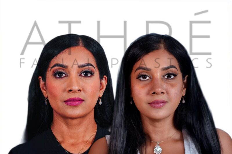 Before and after female rhinoplasty showing enhanced tip refinement and smoother nasal bridge by Dr. Raghu Athré.