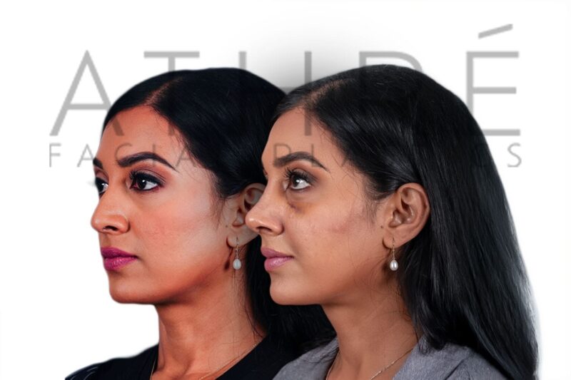Before and after female rhinoplasty with smoother dorsal contour and refined nasal tip by Dr. Raghu Athré.