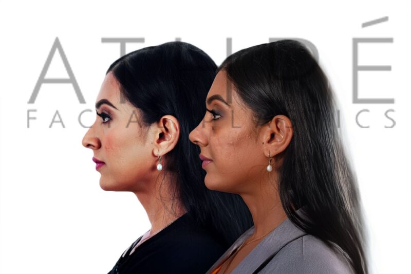 Before and after female rhinoplasty with refined nasal contour and smoother bridge profile by Dr. Raghu Athré.