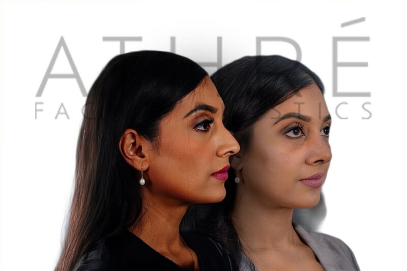 Before and after female rhinoplasty with dorsal hump reduction and enhanced tip structure by Dr. Raghu Athré.