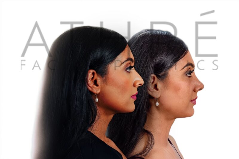Before and after female rhinoplasty showing smoother nasal bridge and refined tip contour by Dr. Raghu Athré.