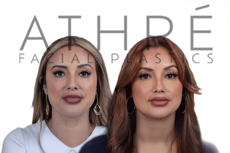 Before and after female rhinoplasty with dorsal hump reduction and enhanced tip refinement by Dr. Raghu Athré.
