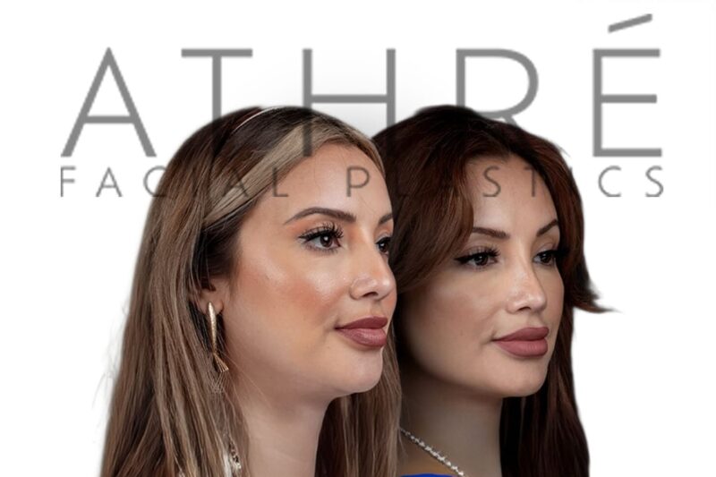 Before and after female rhinoplasty showing smoother bridge contour and refined nasal tip structure by Dr. Raghu Athré.