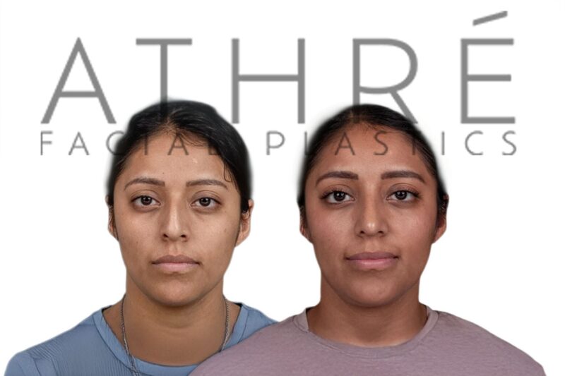 Before and after Hispanic female rhinoplasty with balanced nasal refinement by Dr. Raghu Athré.