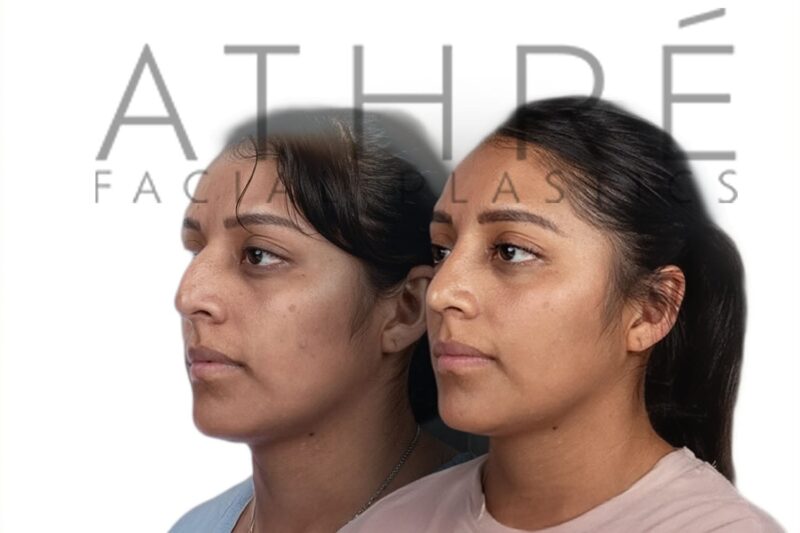 Before and after Hispanic female rhinoplasty with smoother nasal contour by Dr. Raghu Athré.