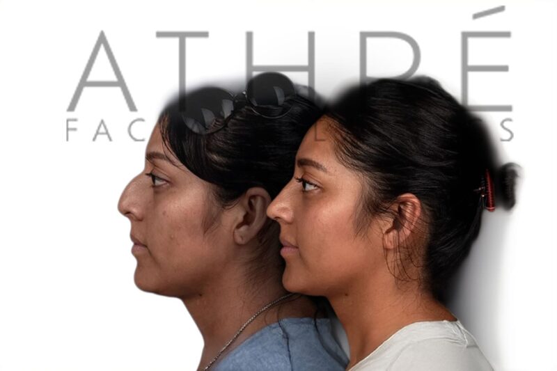 Before and after Hispanic female rhinoplasty showing refined nasal contour by Dr. Raghu Athré.