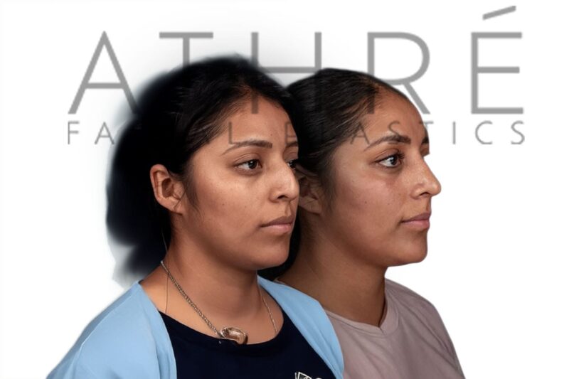Before and after Hispanic female rhinoplasty with refined nasal profile by Dr. Raghu Athré.