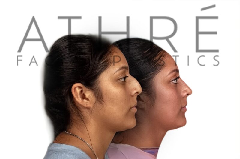 Before and after Hispanic female rhinoplasty with dorsal preservation by Dr. Raghu Athré.