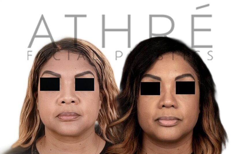Before and after African American female ethnic rhinoplasty with refined nasal contour and enhanced tip definition by Dr. Raghu Athré.