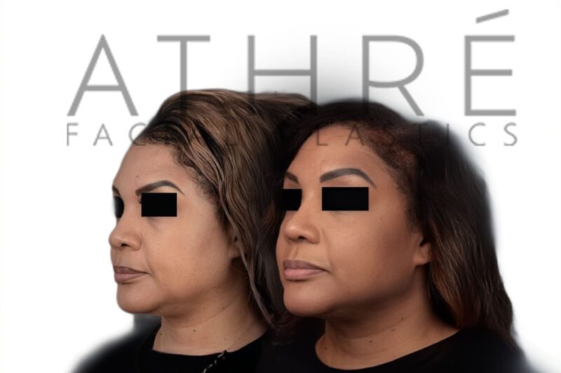 Before and after African American female rhinoplasty with narrowed dorsal contour and refined nasal tip by Dr. Raghu Athré.