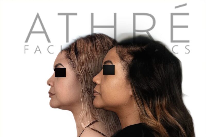 Before and after African American female ethnic rhinoplasty with smoother nasal contour and refined tip definition by Dr. Raghu Athré.