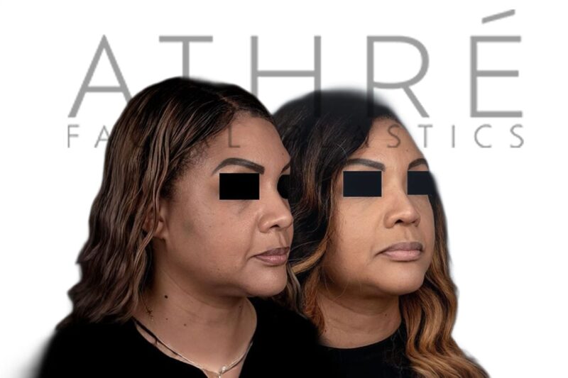 Before and after African American female rhinoplasty with refined nasal tip and narrowed alar base by Dr. Raghu Athré.