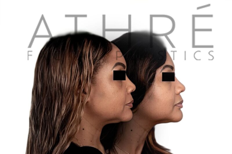 Before and after African American female ethnic rhinoplasty with refined tip definition and narrowed nasal contour by Dr. Raghu Athré.