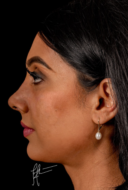 Actual Patient (Here is a photo of a patient having undergone a dorsal preservation rhinoplasty at 4 days. No splint, no packing, minimal bruising).