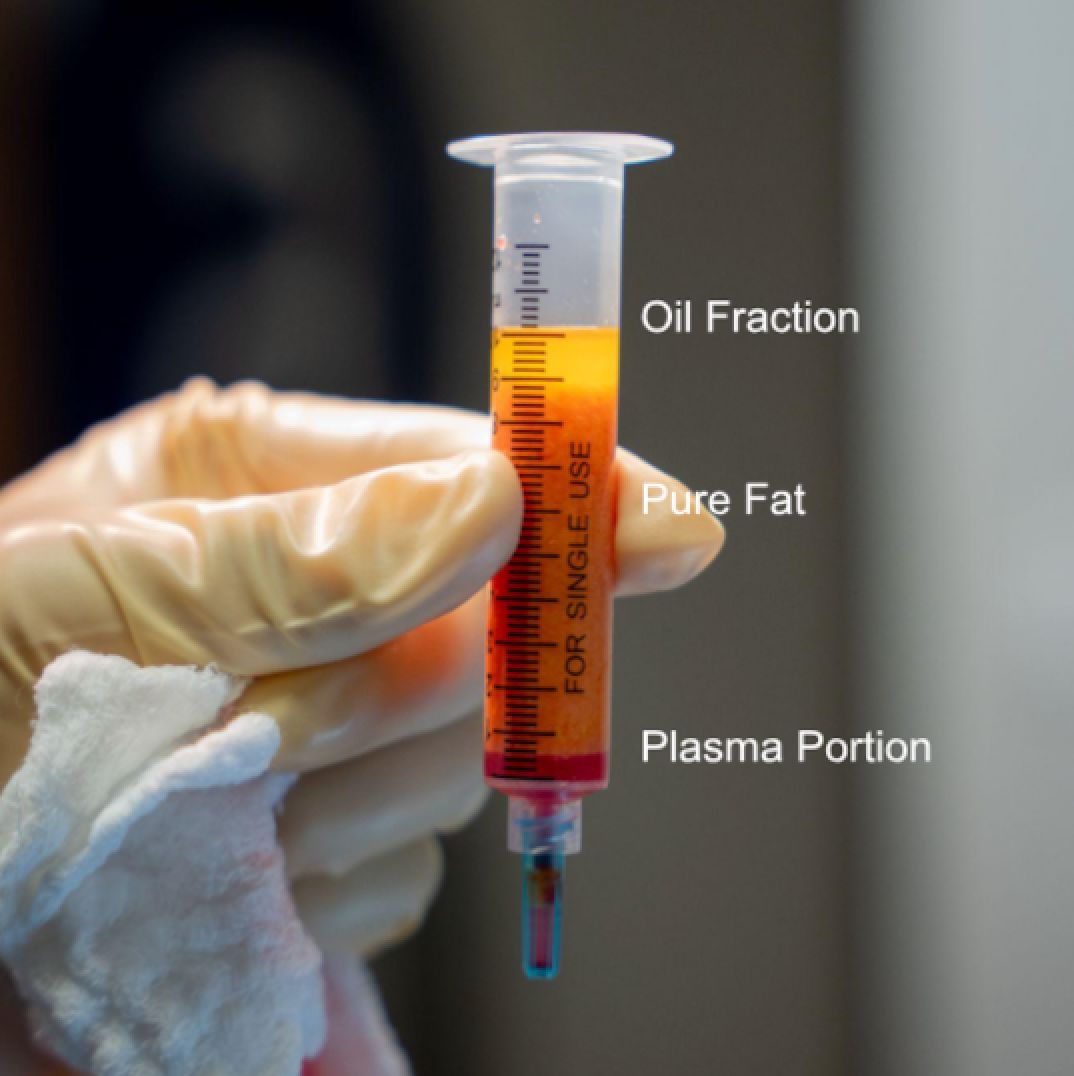 faciaofatsyringe