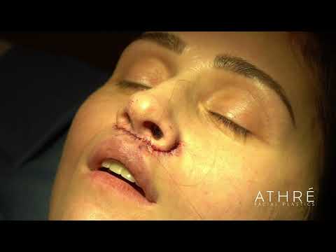 ipliftsurgeryvideo