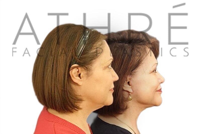 Before and after deep plane facelift and neck lift by Dr. Raghu Athré in 63-year-old female patient.