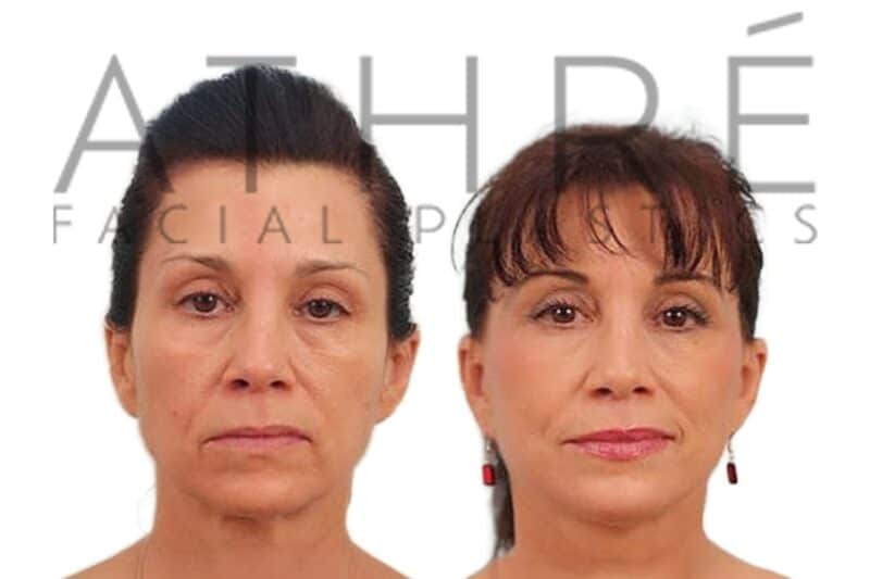 Before and after deep plane facelift and deep neck lift by Dr. Raghu Athré in female patient.