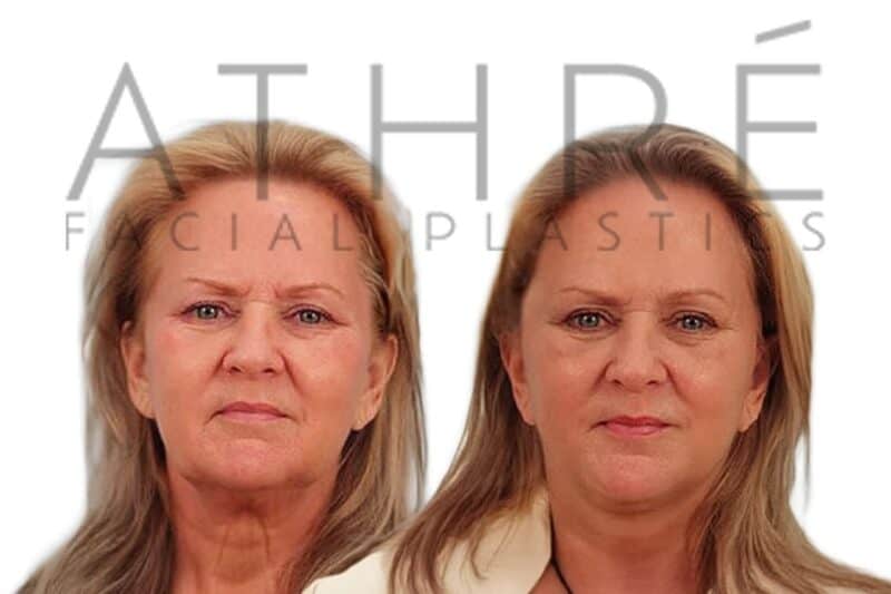 Before and after deep plane facelift and deep neck lift by Dr. Raghu Athré in female patient.