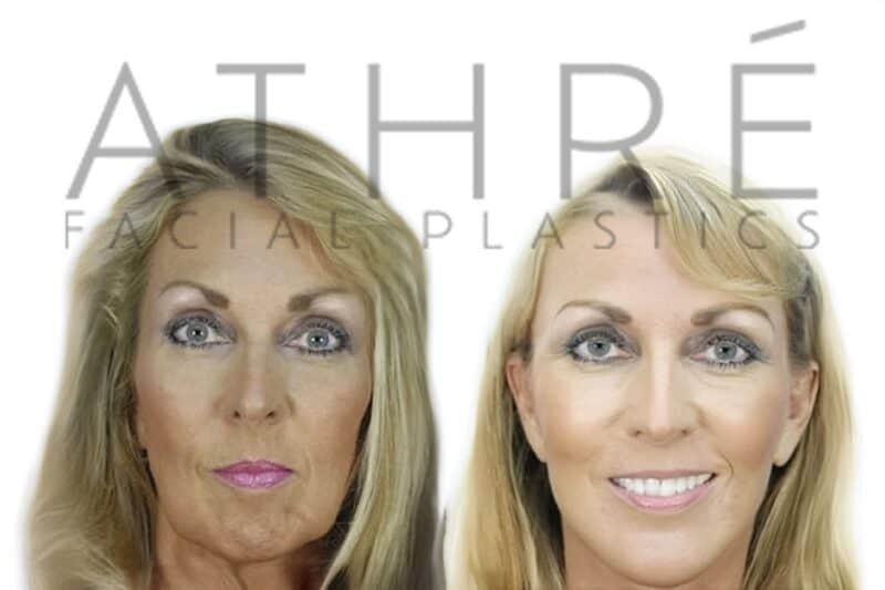 Female patient after 4D Facelift™ and neck rejuvenation surgery by Dr. Raghu Athré.