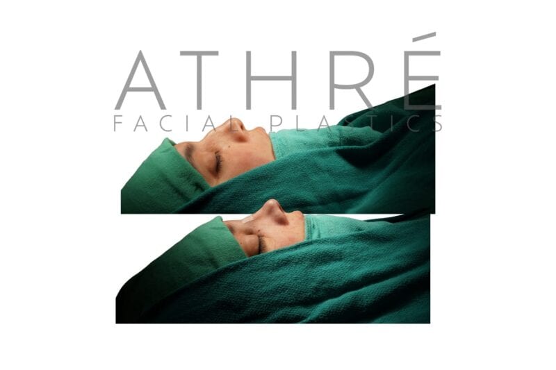 Before and after primary open rhinoplasty in a 33-year-old female patient by Dr. Raghu Athré.