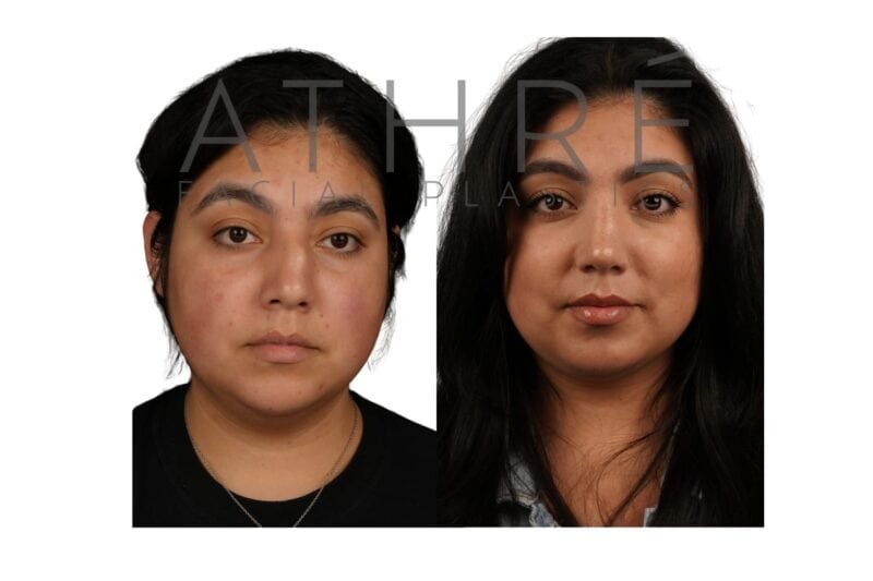 Before and after open rhinoplasty in a 33-year-old female patient with refined nasal contour by Dr. Raghu Athré.