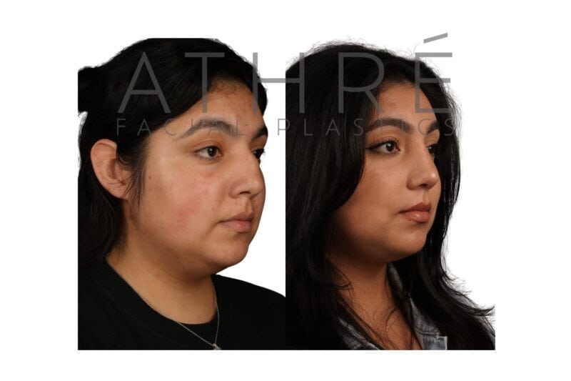 Before and after primary dorsal preservation rhinoplasty in a 33-year-old female patient by Dr. Raghu Athré.