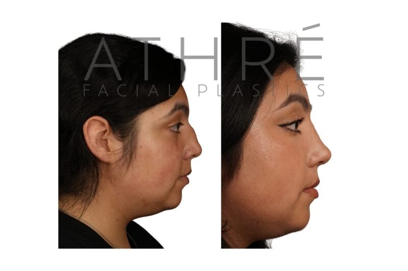 Before and after open primary rhinoplasty with dorsal preservation in a 33-year-old female patient by Dr. Raghu Athré.