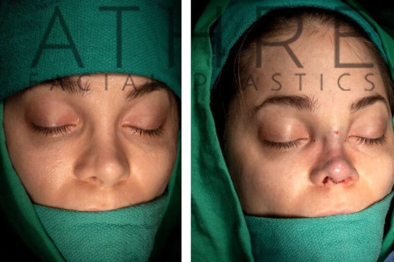 Before and after female revision rhinoplasty with reduced tip bulbousness and refined feminine profile by Dr. Raghu Athré.