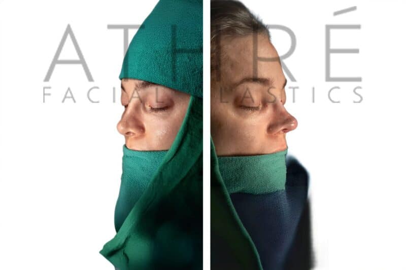 Before and after female revision rhinoplasty with refined nasal tip and feminine profile enhancement by Dr. Raghu Athré.