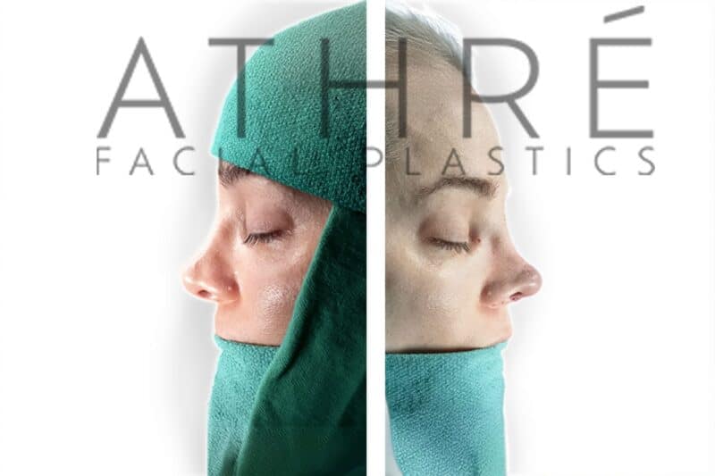 Before and after female revision rhinoplasty correcting bulbous nasal tip by Dr. Raghu Athré.