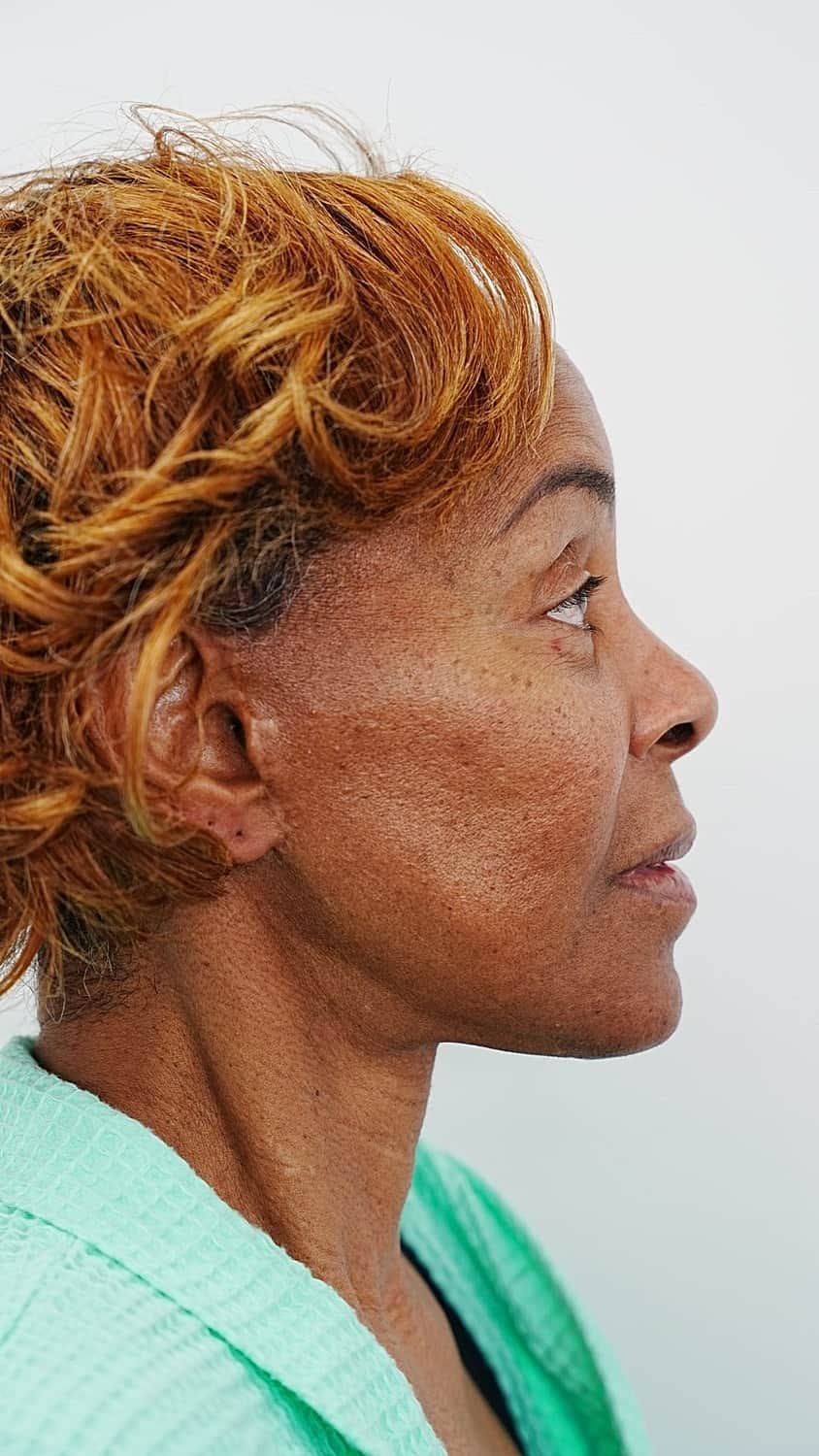 Vivian before revision facelift surgery, profile view