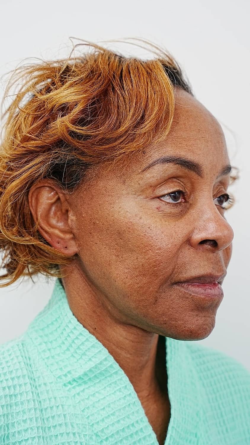 Vivian before revision facelift surgery, oblique view