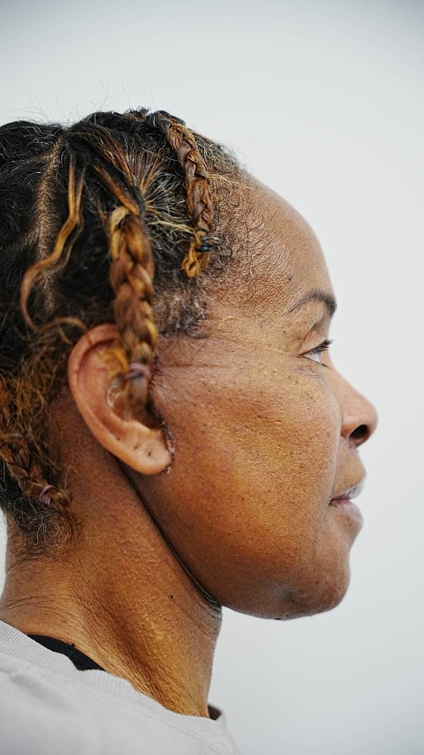 Vivian 7 days after revision facelift surgery, profile view