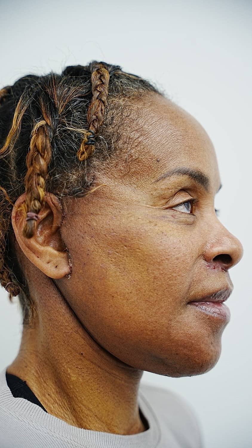 Vivian 7 days after revision facelift surgery, oblique view