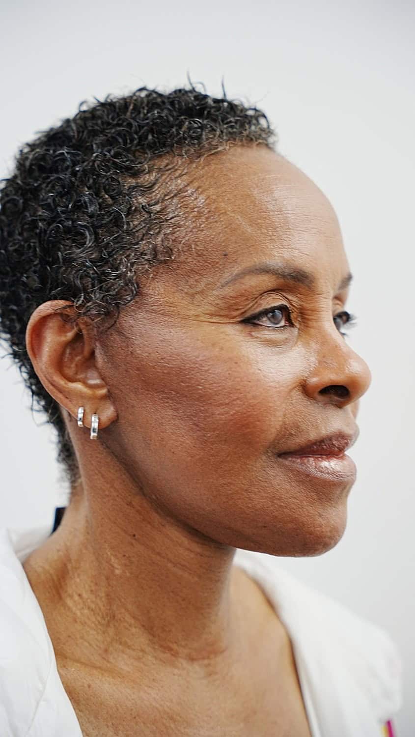 Vivian 1 month after revision facelift surgery, oblique view
