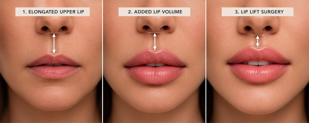 Comparison of an elongated upper lip, added lip volume and surgical lip lifting