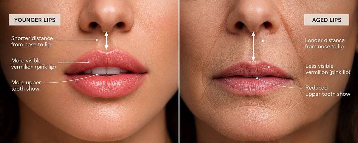 Comparison showing upper lip lengthening, reduced vermilion and less tooth show with aging