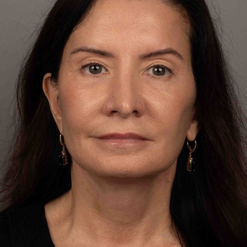 after look of 4D facelift on a woman patient with dark hair